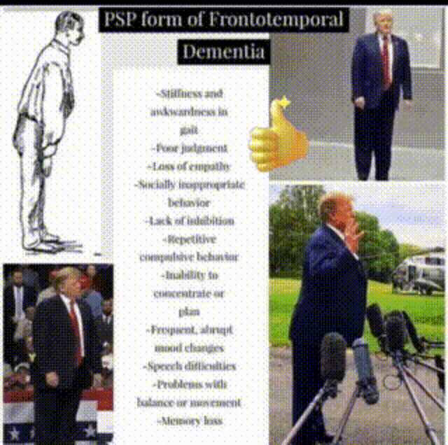 a collage of pictures of donald trump with the words psp form of frontotemporal dementia on the top
