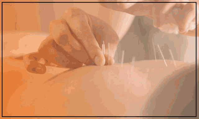 an ad for acupuncture treatment in toronto shows a person getting acupuncture