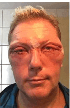 a close up of a man 's face with a bandage on his eye .