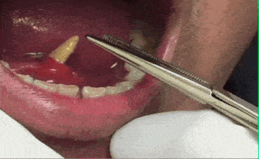 a close up of a person 's mouth with a pair of tweezers sticking out of it