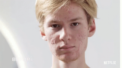 Before And After Skin Decision GIF - Before And After Skin Decision Acne GIFs
