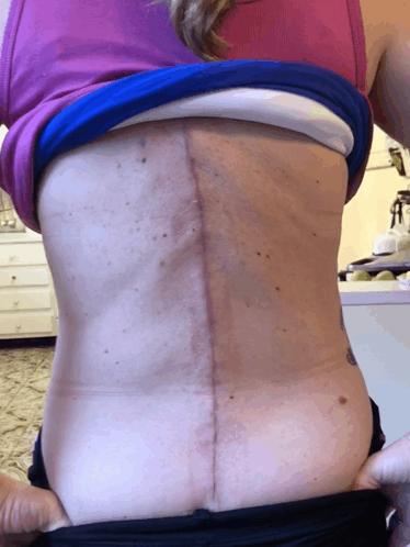 Scoliosis Bad Ass Scar GIF - Scoliosis Bad Ass Scar Get Bent GIFs