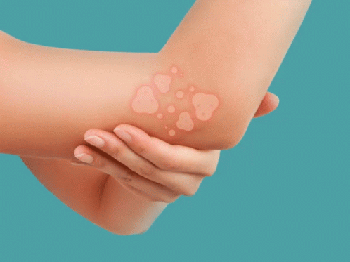 Eczema GIF - Eczema Dry Skin Skin GIFs