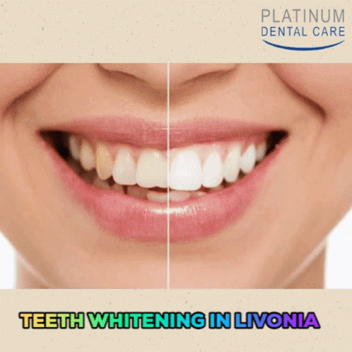 Lumineers In Livonia Lumineers Dental GIF - Lumineers In Livonia Lumineers Dental Teeth Whitening In Livonia GIFs
