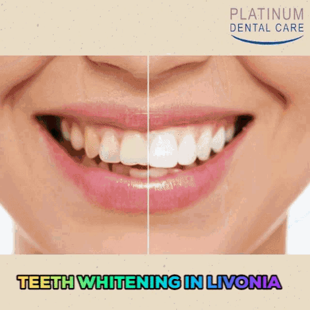 a before and after picture of a woman 's teeth with the words teeth whitening in livonia