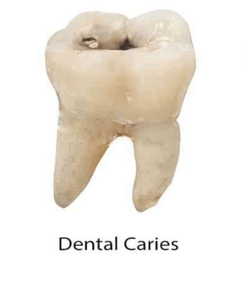 Dental Caries GIF - Dental Caries GIFs