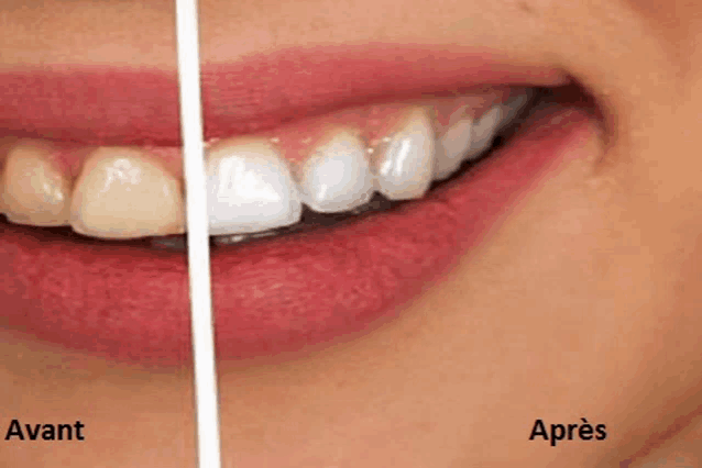 a before and after picture of a woman 's teeth in french .
