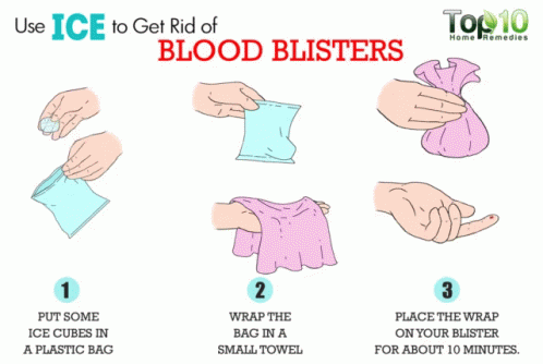 Blister GIF - Blister Blood Blister Get Rid Of GIFs