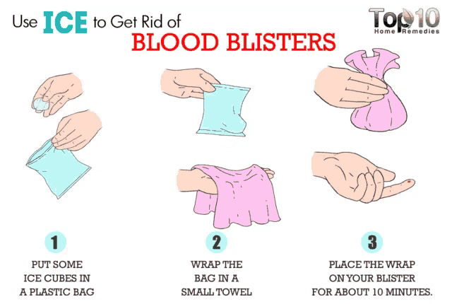a diagram showing how to get rid of blood blisters