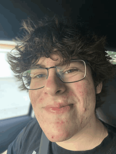 a young man with glasses and red spots on his face is smiling