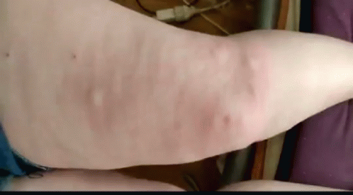 Leg Mosquito Bites GIF - Leg Mosquito Bites Mosquito GIFs