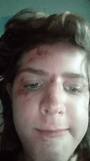 a close up of a person 's face with a bruise on the forehead .