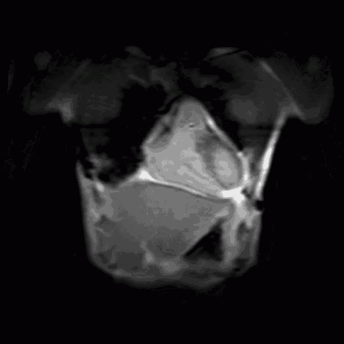 a black and white image of a heart in a person 's body .
