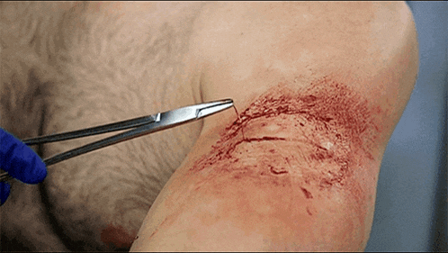 a person is holding a pair of scissors over a wound on their knee