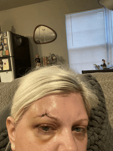 a woman with a stitch on her forehead is sitting on a couch