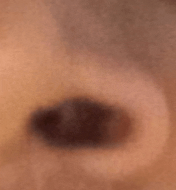 a close up of a person 's eye with a brown spot on it .