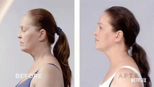 Before And After Skin Decision GIF - Before And After Skin Decision Saggy Skin GIFs