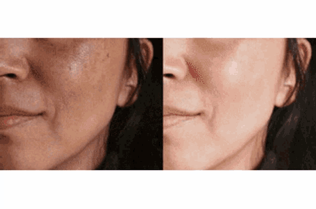 a woman 's face before and after a treatment