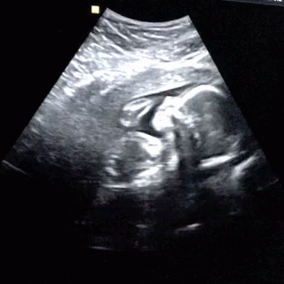 Ultrasound Baby GIF - Ultrasound Baby Preborn GIFs