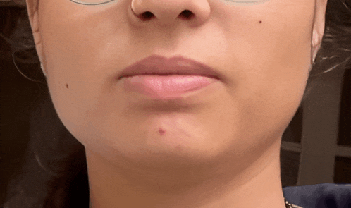 a close up of a woman 's face with a red spot on her chin