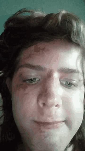 a person with a bruise on their forehead is smiling