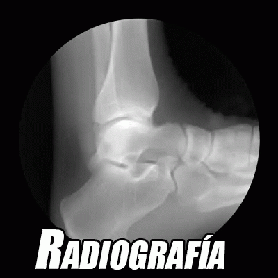 Radiografía De Tobillo GIF