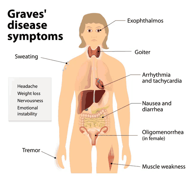 a diagram of the graves disease symptoms