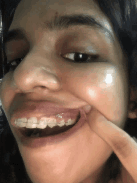 a woman with braces on her teeth is smiling and touching her face