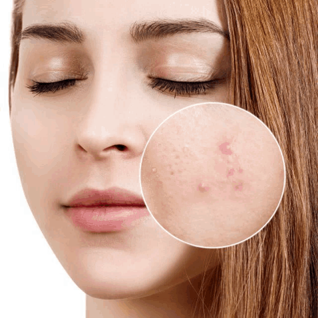 a close up of a woman 's face with a circle of acne on it