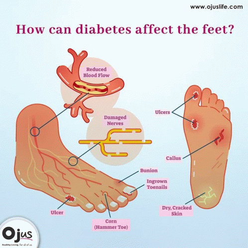 Diabetes Diabetic GIF - Diabetes Diabetic Diabeticneuropathy GIFs
