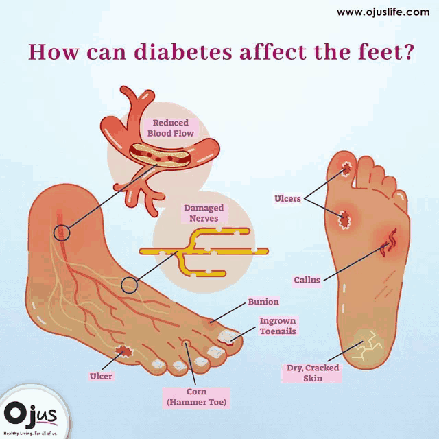 a diagram of how diabetes affects the feet with the website www.ojuslife.com at the bottom