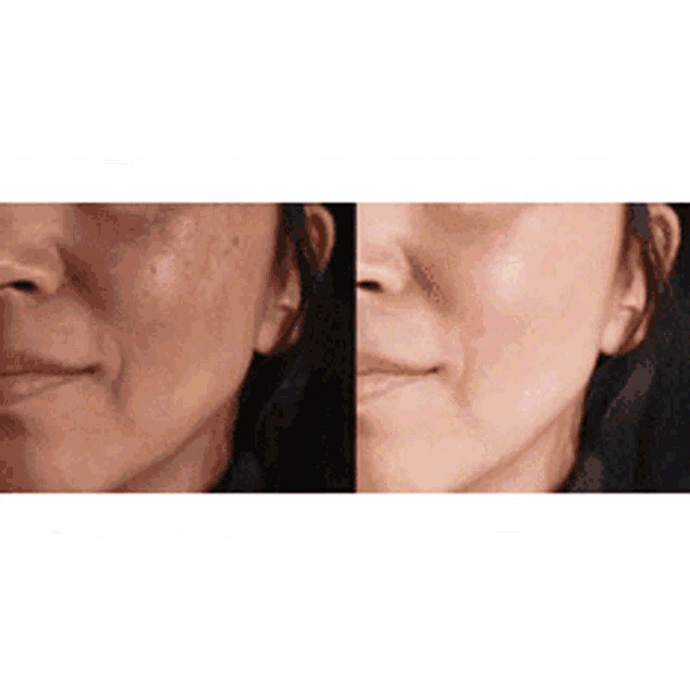 a before and after photo of a woman 's face with a lot of wrinkles .