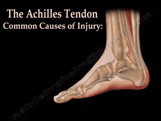 a picture of a foot with the words " the achilles tendon common causes of injury " on it