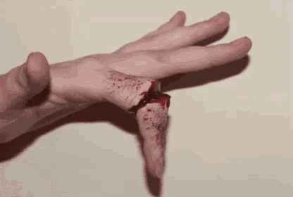 a close up of a person 's hand with a broken finger and blood on it .