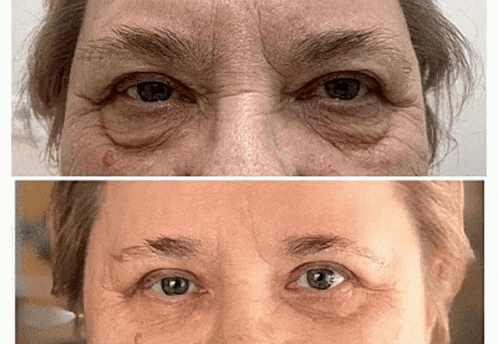 a before and after photo of a woman 's eyes with wrinkles