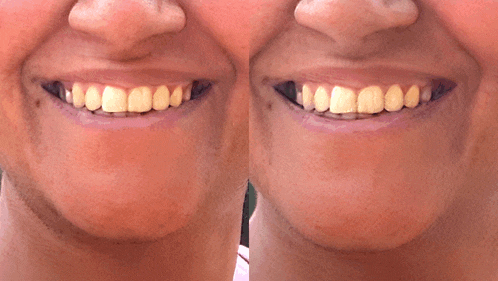 a close up of a woman 's teeth before and after whitening