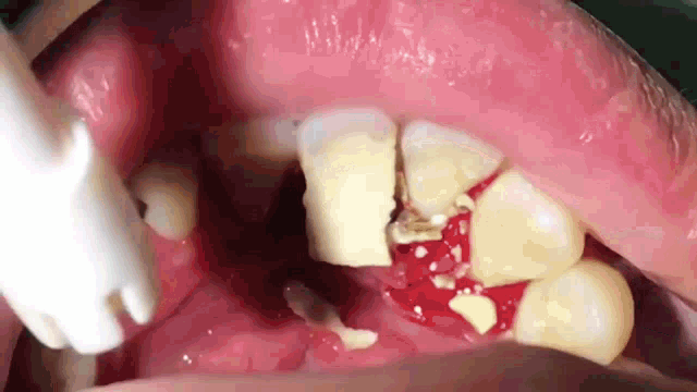 Toothdecaygross GIF - Toothdecaygross GIFs