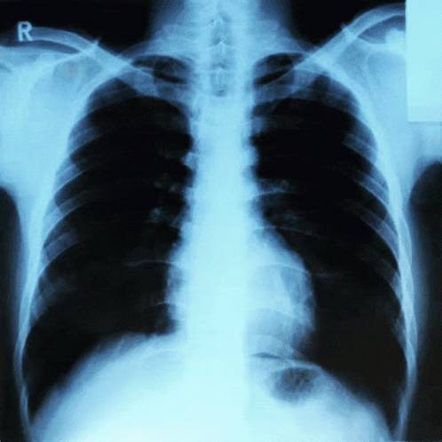 X Ray X Rays GIF - X Ray X Rays Chest X Ray GIFs