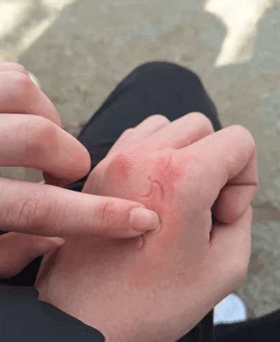 a person is scratching their hand with a smiley face drawn on it