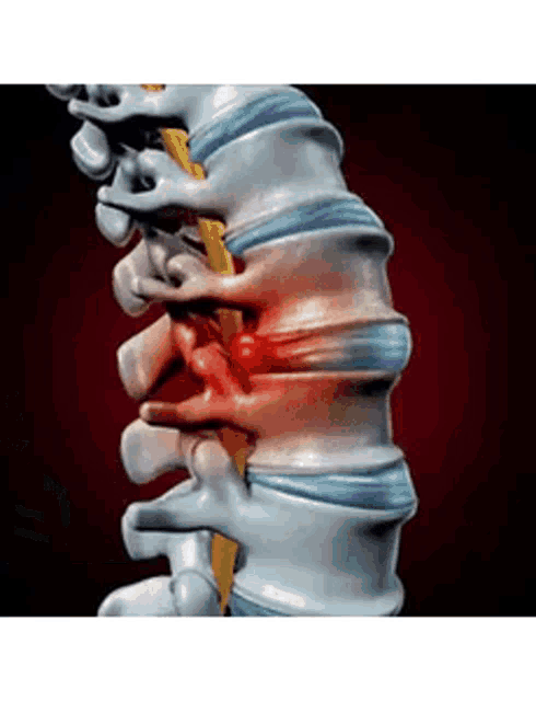 a computer generated image of a person 's spine showing a disc in the back of the spine .