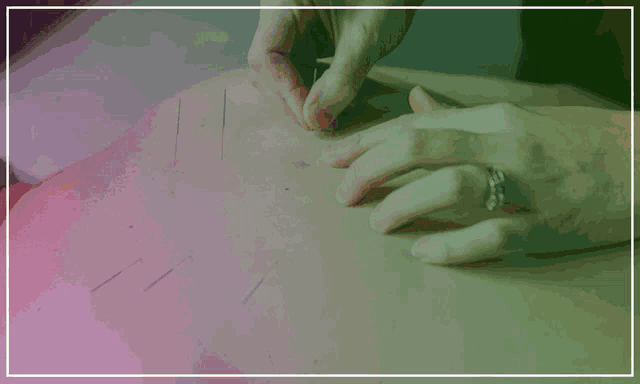 an ad for acupuncture treatment in toronto shows a person getting acupuncture