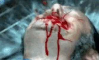 a person with blood coming out of their nose