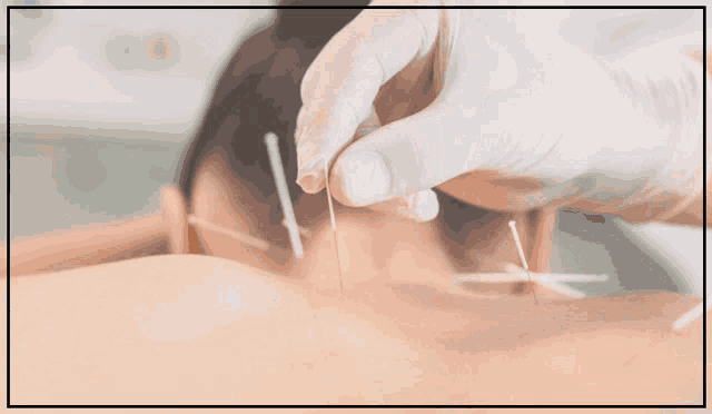 an ad for acupuncture treatment in toronto with a phone number