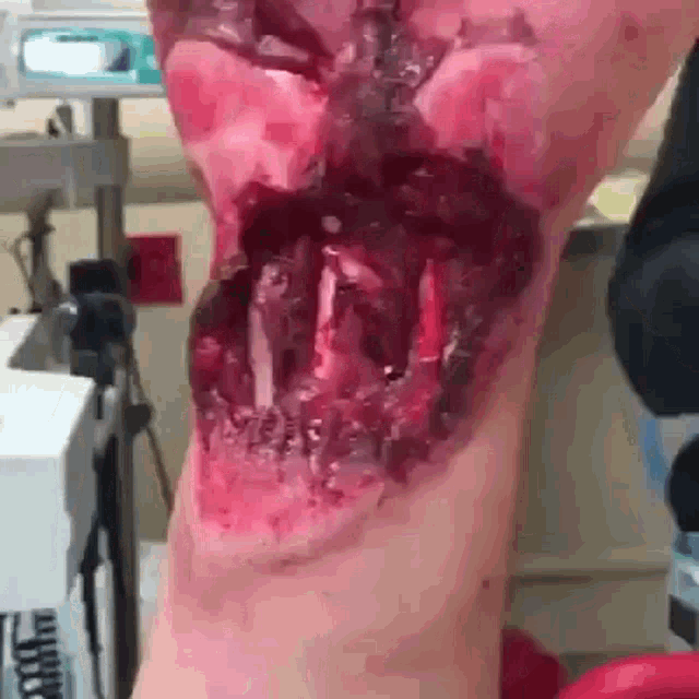 a close up of a wound on a person 's leg
