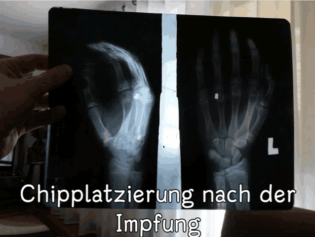 an x-ray of a hand with the words chipplatzierung nach der impfen