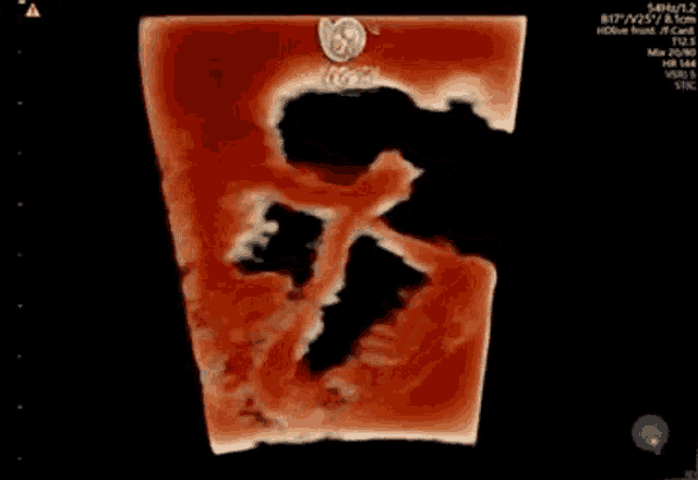 an ultrasound image of a baby 's heart with the letters tcg on the top
