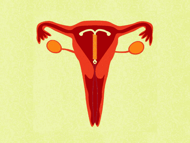 an illustration of a woman 's uterus with a coil in it