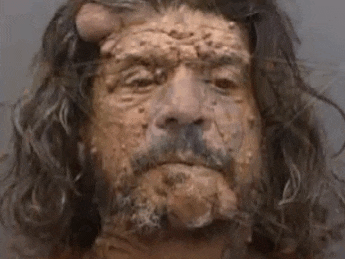 a close up of a man 's face with a beard and a large bump on his forehead .