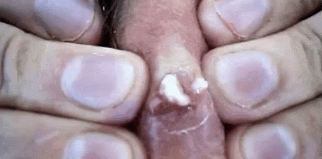 Infection GIF - Infection Gross Puss GIFs