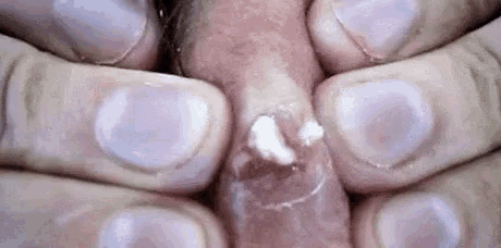 a close up of a person 's fingers holding a pimple on their face .